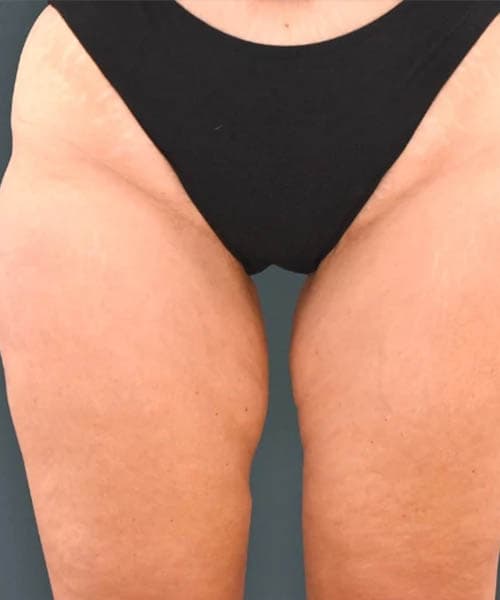 Before fat freezing treatment 4