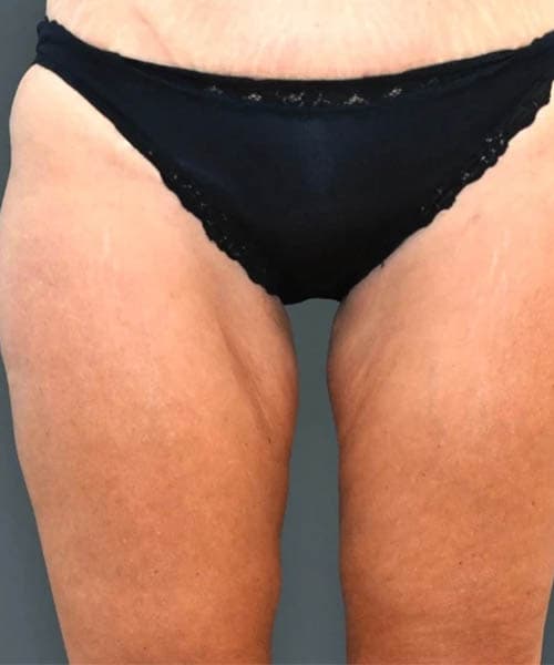 After fat freezing treatment 4